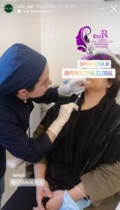 نمونه کار زاویه سازی صورت دکتر رجا قلیان در ساری