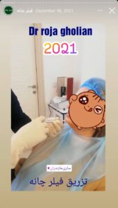 نمونه کار زاویه سازی صورت دکتر رجا قلیان در ساری