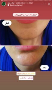 نمونه کار زاویه سازی صورت دکتر رجا قلیان در ساری