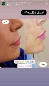 نمونه کار زاویه سازی صورت دکتر رجا قلیان در ساری