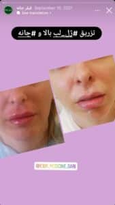 نمونه کار زاویه سازی صورت دکتر رجا قلیان در ساری