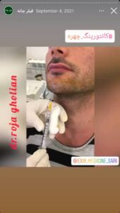 نمونه کار زاویه سازی صورت دکتر رجا قلیان در ساری