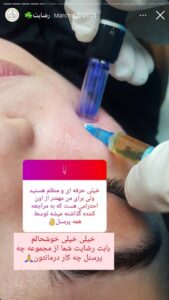 نمونه کار زاویه سازی صورت کلینیک مه رخ در ساری