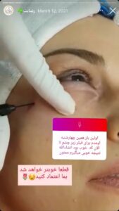 نمونه کار زاویه سازی صورت کلینیک مه رخ در ساری