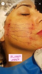 نمونه کار زاویه سازی صورت کلینیک مه رخ در ساری