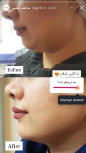 نمونه کار زاویه سازی صورت کلینیک مه رخ در ساری