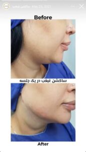 نمونه کار زاویه سازی صورت کلینیک مه رخ در ساری