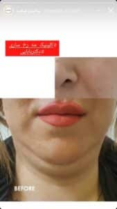 نمونه کار زاویه سازی صورت کلینیک مه رخ در ساری