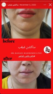 نمونه کار زاویه سازی صورت کلینیک مه رخ در ساری