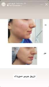 نمونه کار زاویه سازی صورت کلینیک مه رخ در ساری