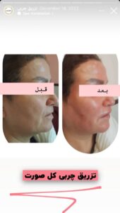 نمونه کار زاویه سازی صورت کلینیک مه رخ در ساری