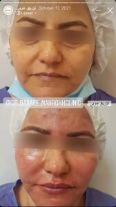 نمونه کار زاویه سازی صورت کلینیک مه رخ در ساری