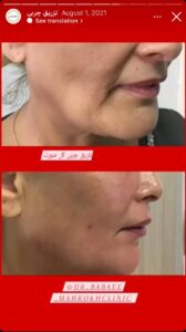 نمونه کار زاویه سازی صورت کلینیک مه رخ در ساری