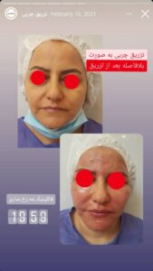 نمونه کار زاویه سازی صورت کلینیک مه رخ در ساری