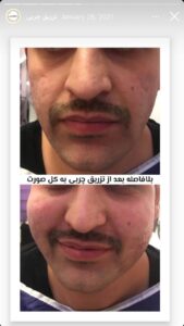 نمونه کار زاویه سازی صورت کلینیک مه رخ در ساری