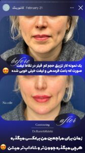 نمونه کار زاویه سازی صورت دکتر راضیه ملکی در ساری