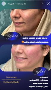 نمونه کار زاویه سازی صورت دکتر راضیه ملکی در ساری
