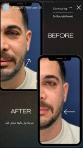 نمونه کار زاویه سازی صورت دکتر راضیه ملکی در ساری