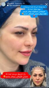 نمونه کار زاویه سازی صورت دکتر راضیه ملکی در ساری