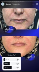 نمونه کار زاویه سازی صورت دکتر راضیه ملکی در ساری