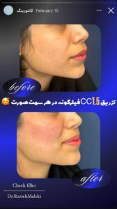 نمونه کار زاویه سازی صورت دکتر راضیه ملکی در ساری