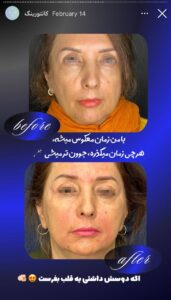 نمونه کار زاویه سازی صورت دکتر راضیه ملکی در ساری