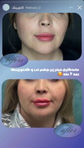 نمونه کار زاویه سازی صورت دکتر راضیه ملکی در ساری