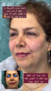 نمونه کار زاویه سازی صورت دکتر راضیه ملکی در ساری