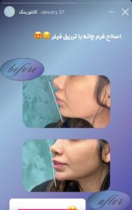 نمونه کار زاویه سازی صورت دکتر راضیه ملکی در ساری