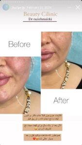 نمونه کار زاویه سازی صورت دکتر راضیه ملکی در ساری