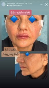 نمونه کار زاویه سازی صورت دکتر راضیه ملکی در ساری