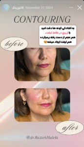 نمونه کار زاویه سازی صورت دکتر راضیه ملکی در ساری