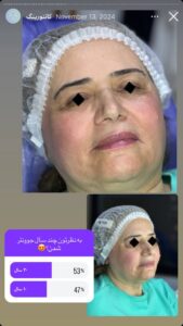 نمونه کار زاویه سازی صورت دکتر راضیه ملکی در ساری