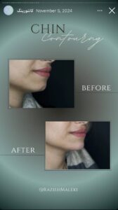 نمونه کار زاویه سازی صورت دکتر راضیه ملکی در ساری