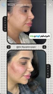 نمونه کار زاویه سازی صورت دکتر راضیه ملکی در ساری