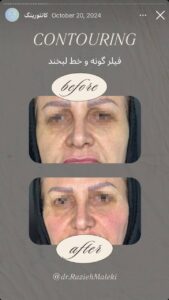 نمونه کار زاویه سازی صورت دکتر راضیه ملکی در ساری