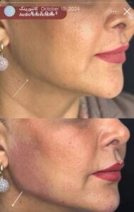 نمونه کار زاویه سازی صورت دکتر راضیه ملکی در ساری