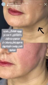 نمونه کار زاویه سازی صورت دکتر راضیه ملکی در ساری