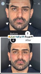 نمونه کار زاویه سازی صورت دکتر راضیه ملکی در ساری