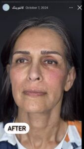 نمونه کار زاویه سازی صورت دکتر راضیه ملکی در ساری