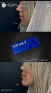 نمونه کار زاویه سازی صورت دکتر راضیه ملکی در ساری