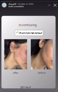 نمونه کار زاویه سازی صورت دکتر راضیه ملکی در ساری