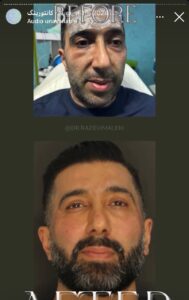 نمونه کار زاویه سازی صورت دکتر راضیه ملکی در ساری