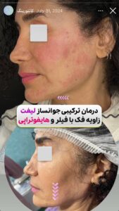 نمونه کار زاویه سازی صورت دکتر راضیه ملکی در ساری
