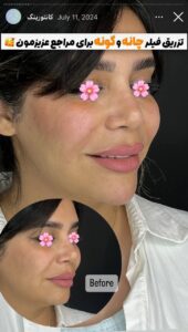 نمونه کار زاویه سازی صورت دکتر راضیه ملکی در ساری