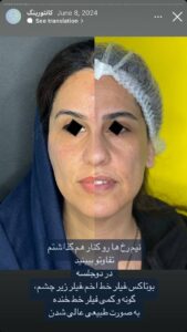 نمونه کار زاویه سازی صورت دکتر راضیه ملکی در ساری