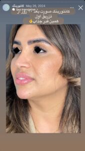 نمونه کار زاویه سازی صورت دکتر راضیه ملکی در ساری