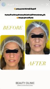 نمونه کار زاویه سازی صورت دکتر راضیه ملکی در ساری