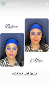 نمونه کار زاویه سازی صورت دکتر راضیه ملکی در ساری