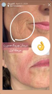 نمونه کار زاویه سازی صورت دکتر راضیه ملکی در ساری